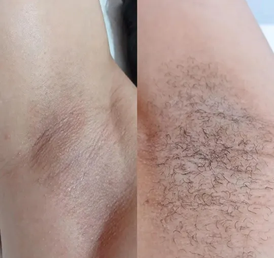 Axila antes e depois da depilação com cera