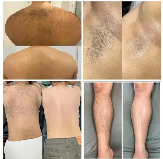 Antes e depois de depilação masculina em costas, axilas e pernas